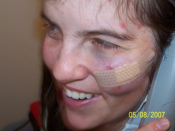A ball to the cheek bone 2 stiches later... 05/08/2007