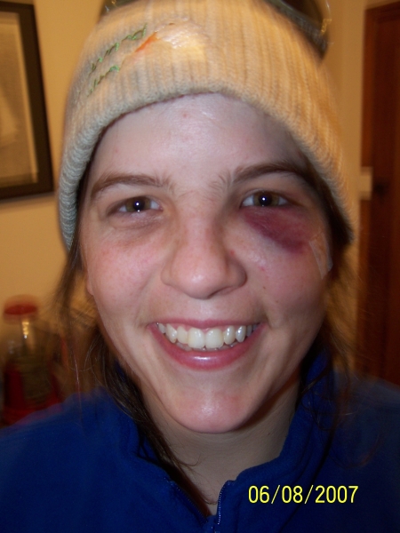 A ball to the cheek bone 2 stiches later... 05/08/2007
