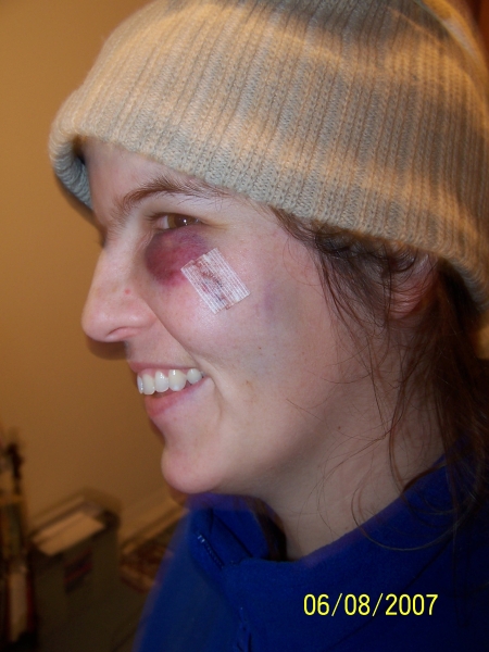 A ball to the cheek bone 2 stiches later... 05/08/2007