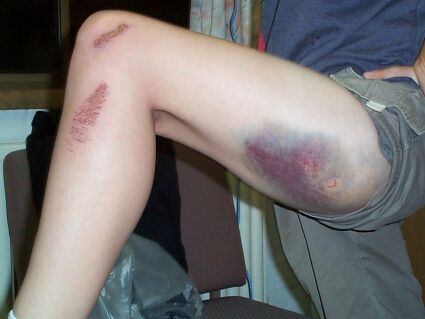Injury from falling off skates