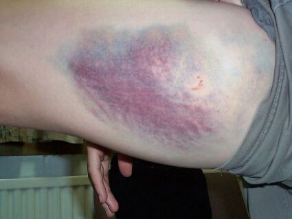 Injury from falling off skates