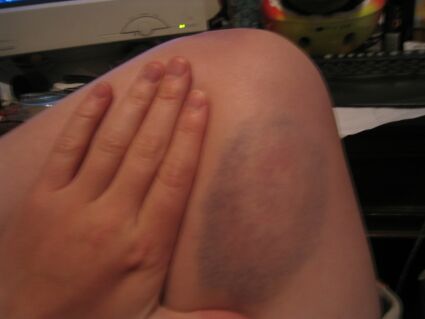 Whacked with a hockey ball - 14/11/2004