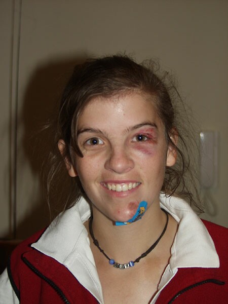 Got into a fight, bike vs tram tracks... I lost - 27/4/2005, other injuries: bruised hip, skinned knees, and grazed jaw, ashphalt is fine and so is bike