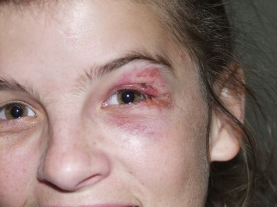 Got into a fight, bike vs tram tracks... I lost - 27/4/2005
